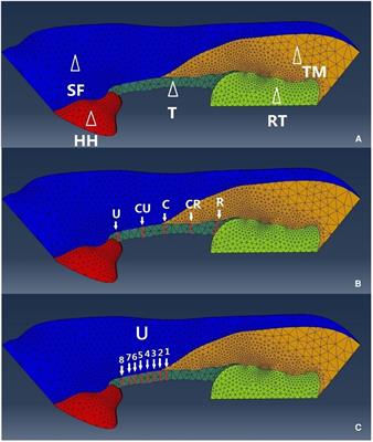 A finite element analysis of the carpal arch with various locations of carpal tunnel release